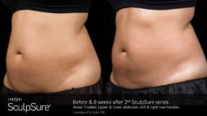 Sculpsure results