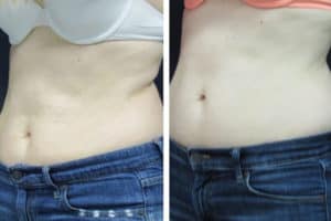 Sculpsure stomach