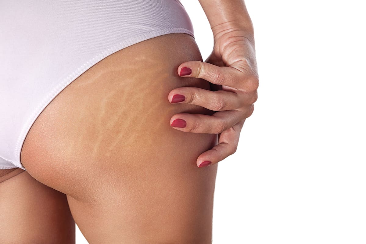 Woman's thigh with Stretch marks 