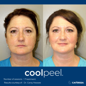 Cartesa CoolPeel image front view before and after