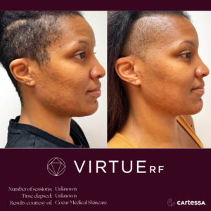 African American Woman Before and After Virtue RF