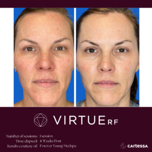 Caucasian woman before and after Virtue RF