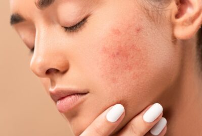 woman with acne